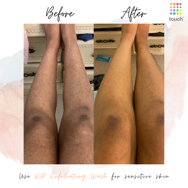Before and after KP Wash And Lotion - Touch Skin Care