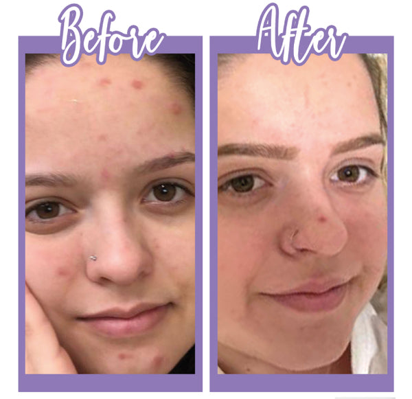 Before and After - Bright And Clear - Touch Skin Care