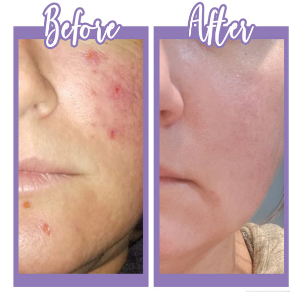 Before and After - Bright and clear - Touch Skin Care