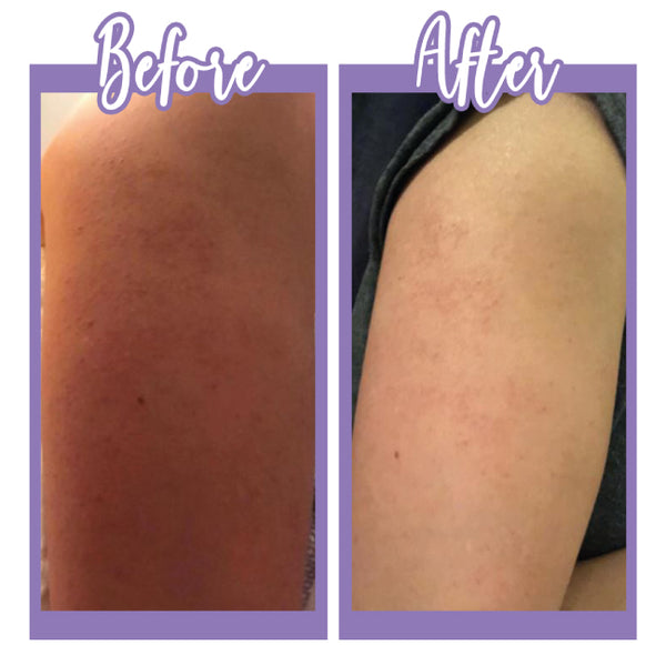 Before and After Kp lotion & Wash - Touch Skin Care