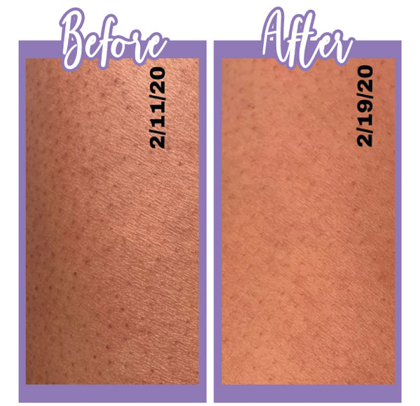 Before and after KP Wash and Lotion - Touch Skin Care