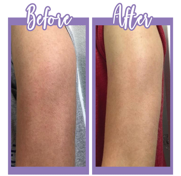 Before and After - KP wash and Lotion - Touch Skin Care