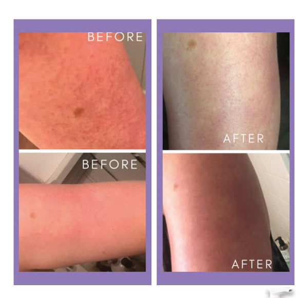 Before and after - KP Wash And Lotion - Touch Skin Care