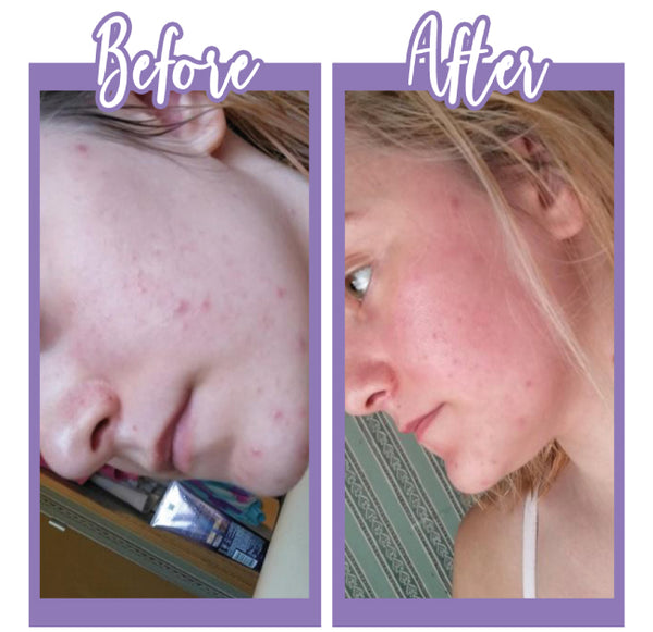 Before and After Acne treatment Gel - Touch Skin Care