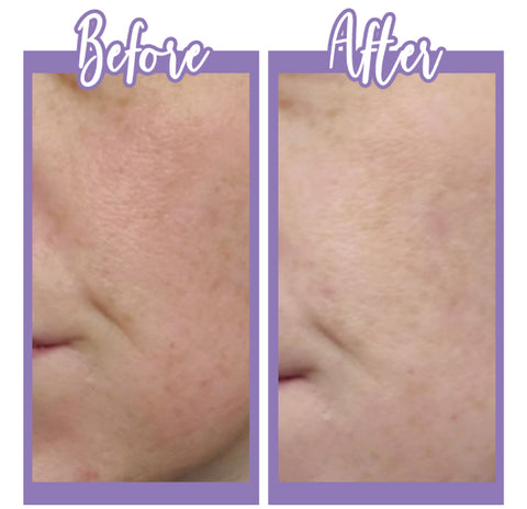 Before and after Glycolic Acid Toner - Touch Skin Care