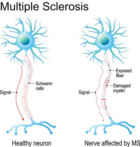 MS - Esclerose múltipla antiga