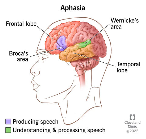 뇌졸중 또는 apshasia
