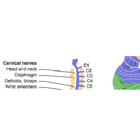 SCI - Blessure de la moelle épinière - quadriplégie C5