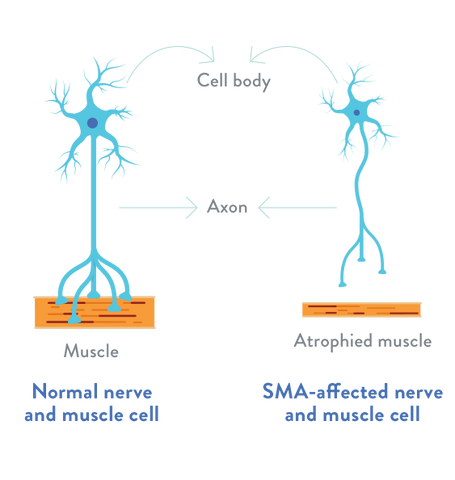 SMA - atrophie musculaire spinale