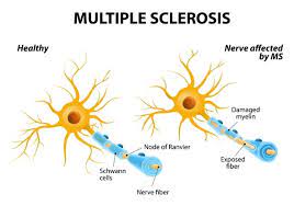 MS - esclerose múltipla