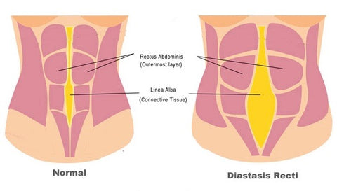 Diastasis Recti Safe Exercises! – Belly Bandit