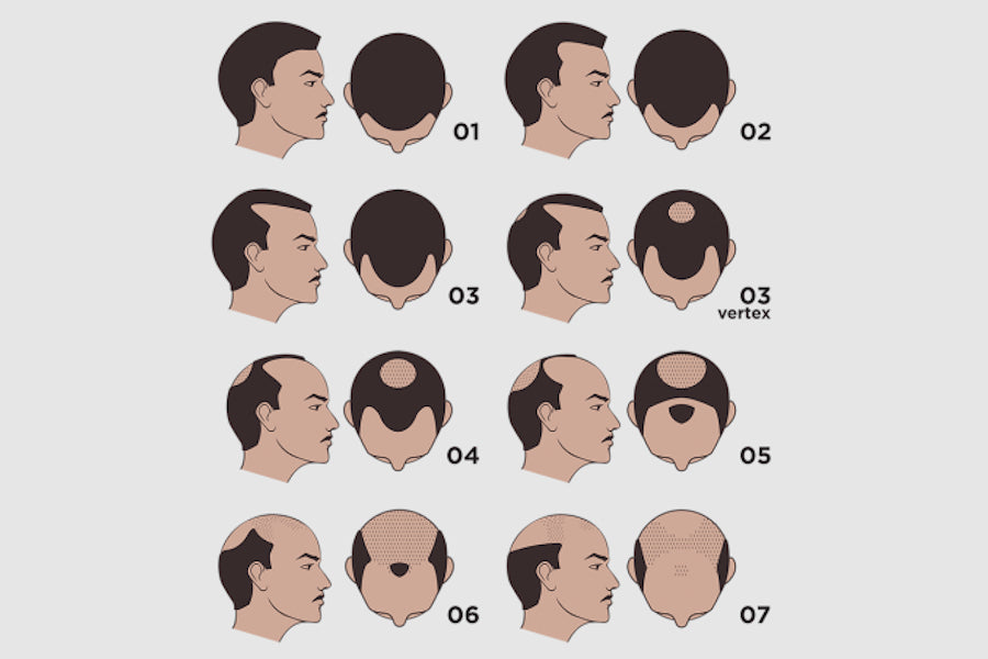 Male Pattern Baldness Causes Stages  Treatments