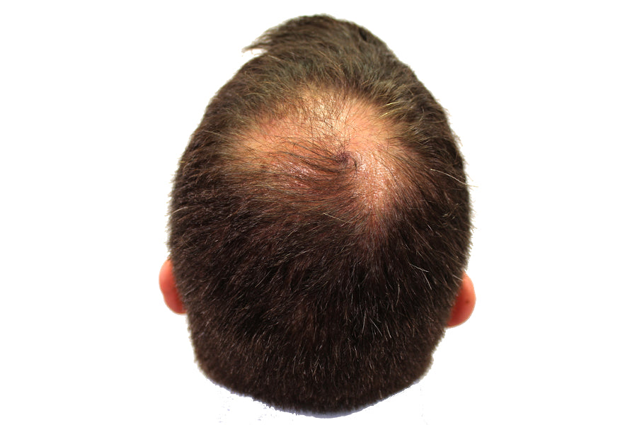 Hair Loss Treatment PRP is Not a DHT Blocker but DHT is Not the Only  Cause of Pattern Hair Loss  YouTube