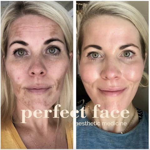 Chemical Peel Before & After