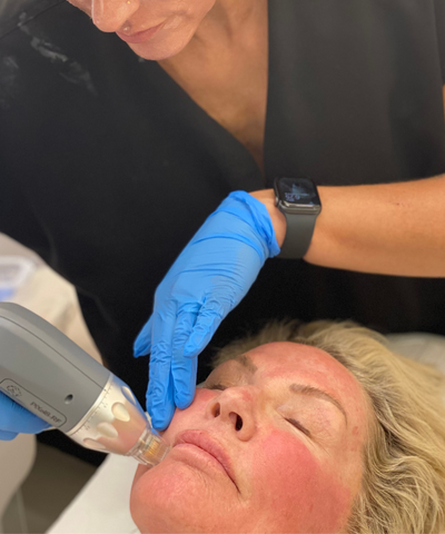 Radiofrequency Microneedling