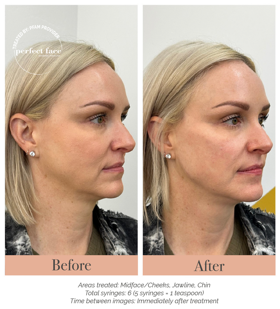 Facial Balancing Before and After Photo