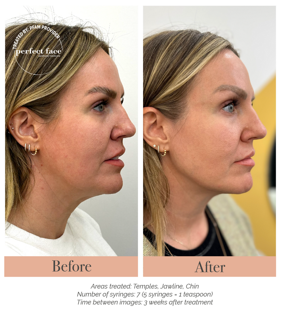 Facial Balancing Before and After Photo