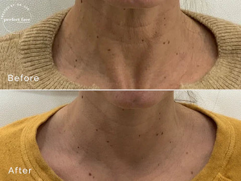 filler radiesse before and after