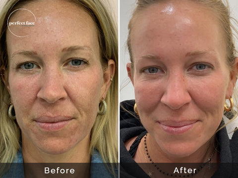 The Microneedling Rundown Aesthetic and Before Photos After With Perfect Medicine – Face