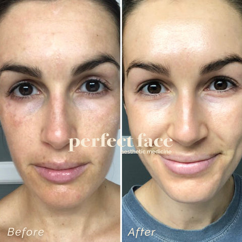 Retinol Before and After Photo