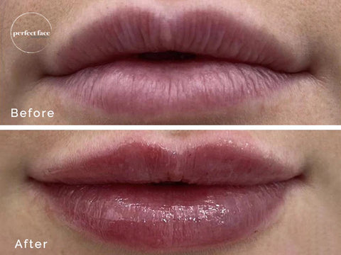 filler before and after photo