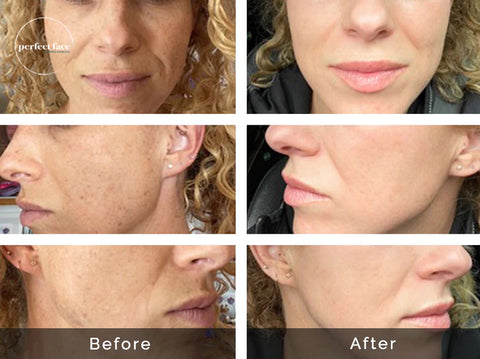 The Myths And Facts Of Retinol With Before And After Photos – Perfect Face  Aesthetic Medicine