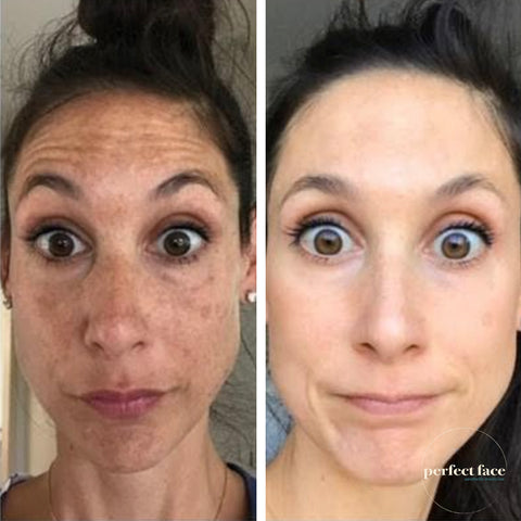 Melasma Skincare Before & After