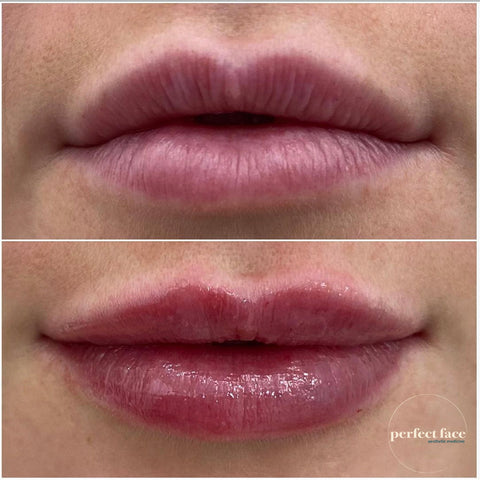 Lip Filler Before And After