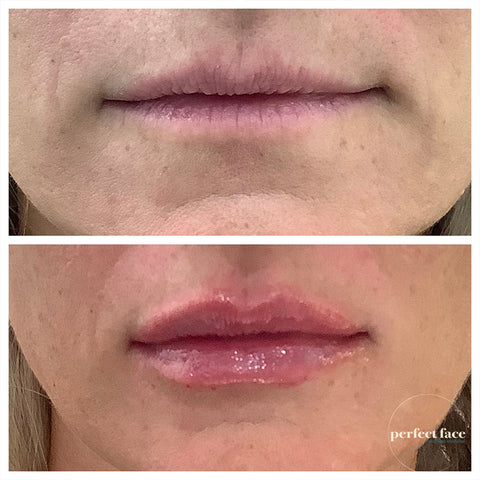 Lips Before And After