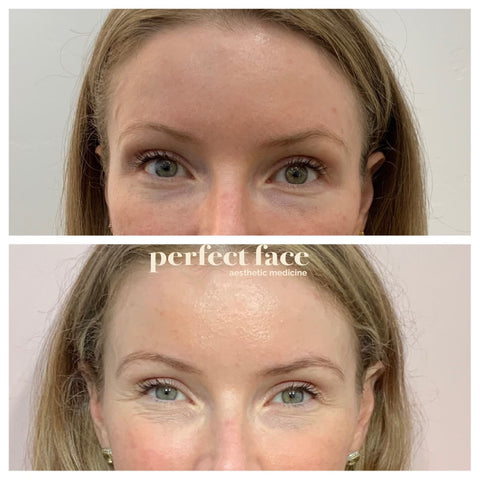 PDO THREAD LIFT  Align Injectable Aesthetics