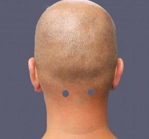 back of a man's head with two blue dots at the base of his neck