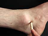 foot with a tool pressing against calcaneus black background