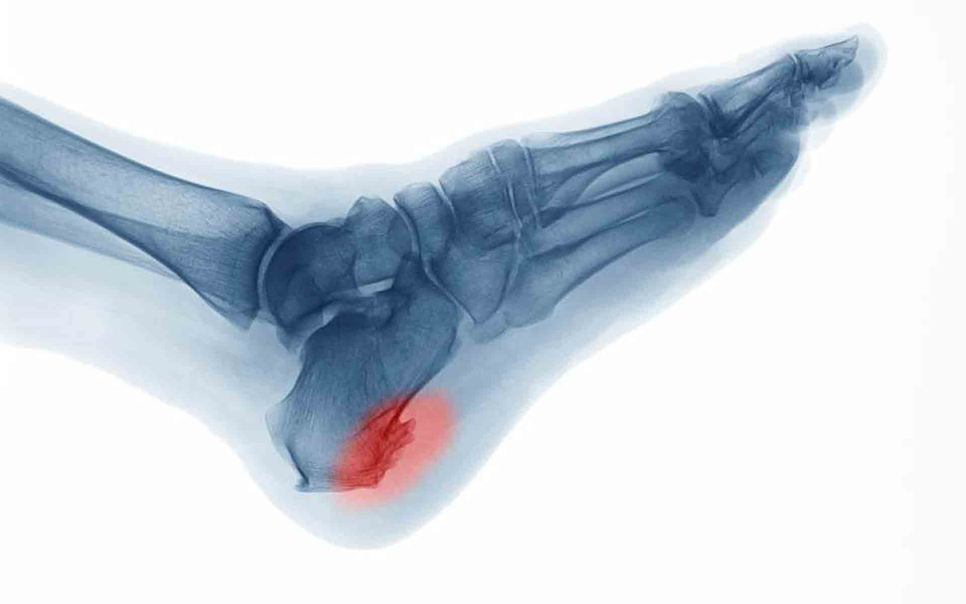 Cómo tratar la fascitis plantar