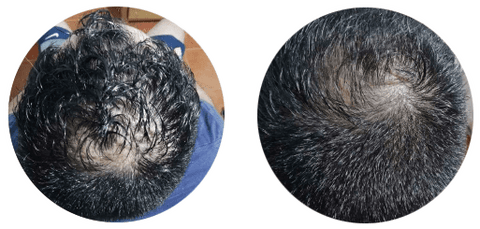 Alopecia Androgénica. 3 Meses de tratamiento