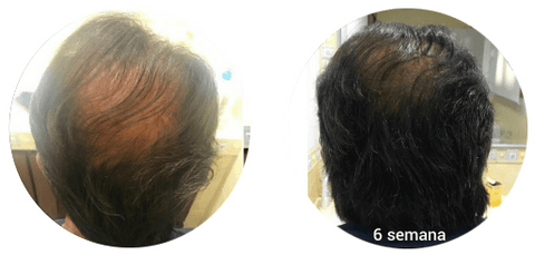 Alopecia Androgénica. 6 Semanas de tratamiento.