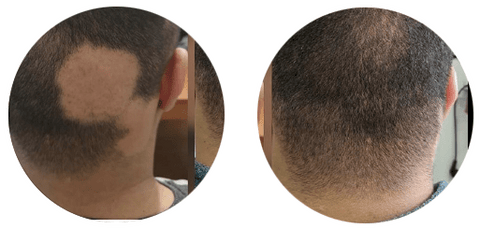 Alopecia Areata. 2 Meses de tratamiento