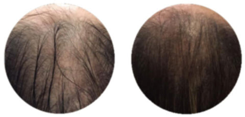 Alopecia Androgénica. 6 Semanas de tratamiento