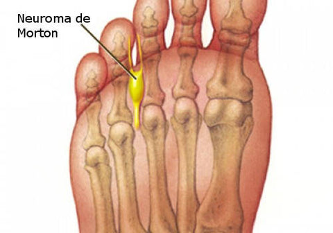 neuroma de morton