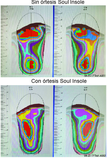 ortesis plantares postura