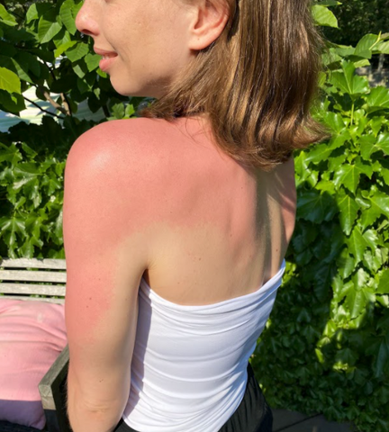 Woman with sunburn