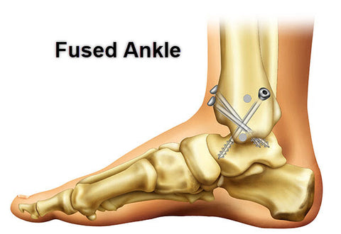 Z-CoiL fused ankle shoes is effective 