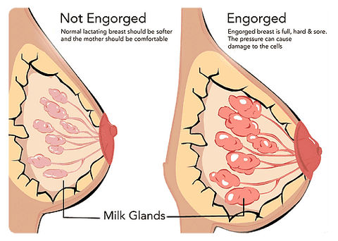 Breast Engorgement in Breastfeeding Mothers - Breastfeeding