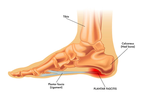 A MILE IN MY SHOES – PLANTAR FASCIITIS - Lure Essentials