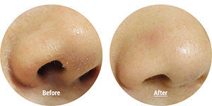 Blackheads Removal Mask Before and After