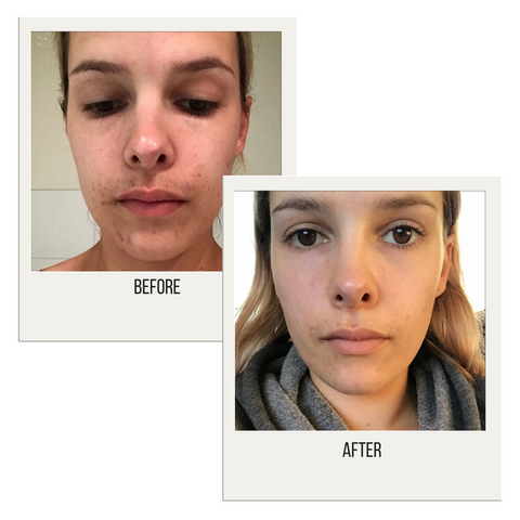 Skin before and after using Oxygen natural skincare