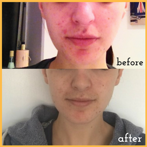 problem skin before and after