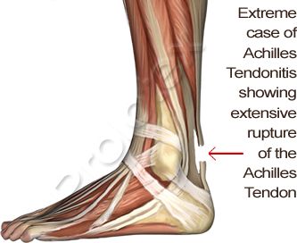 Achilles Tendonitis | Treating Achilles Tendonitis | TherapySocks.com