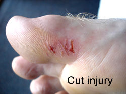 laceration, cut to foot