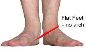 Bio Ceramic Socks Reduce Flat Foot Pain 