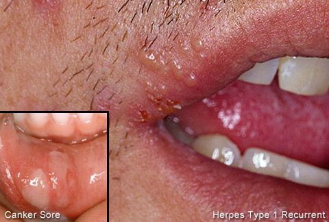 Cacao Butter helps fight and heal cold sores